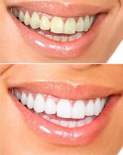 Teeth Whitening Gels