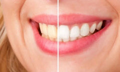 Teeth Whitening Gels